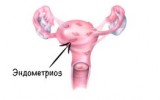 Фото: Эндометриоз матки