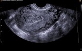 Фото: Эндометриоз на УЗИ