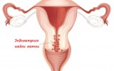 Фото: Эндометриоз шейки матки
