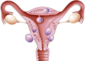 Фото:внутренний эндометриоз тела матки