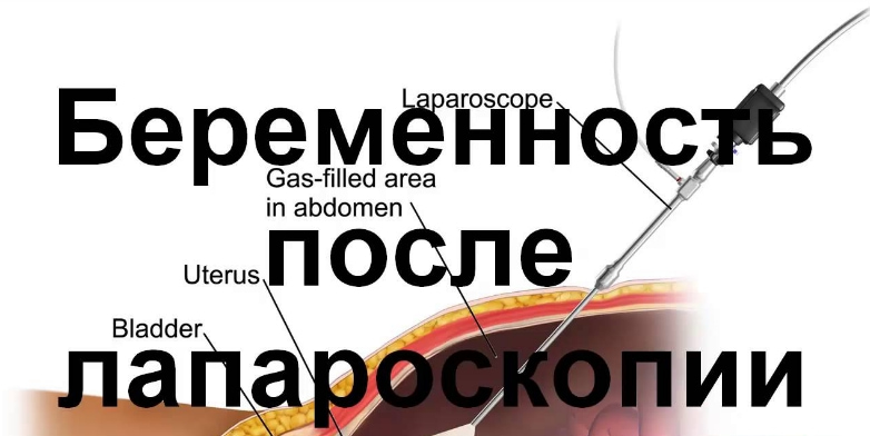 Фото: Беременность после лапароскопии эндометриоза