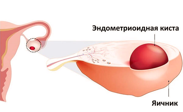 Фото: Патогенез эндометриоз