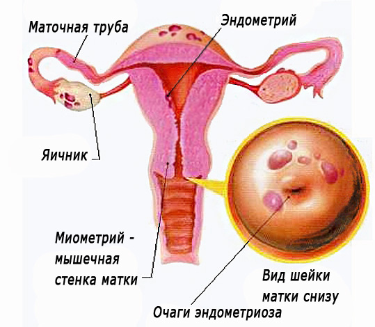 Фото: Что такое эндометриоз шейки матки